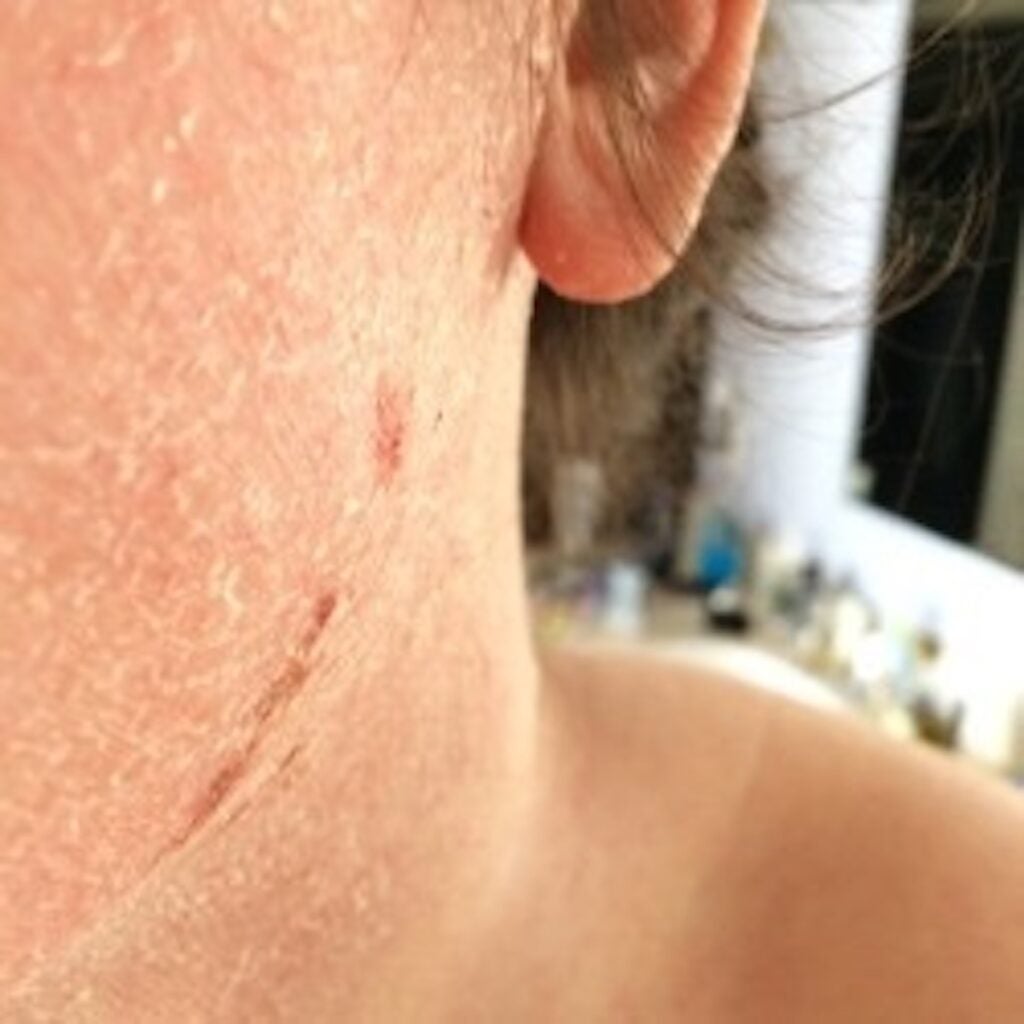 Summer Forlenza's severe eczema flare-ups kept her from having a social life. (Courtesy of Summer Forlenza)